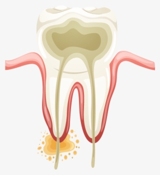 Root-canal1 - Endodontic Vector #7824445