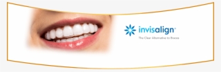 Invisalign San Luis Obispo Ca - Clear Aligners #7907866