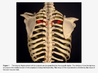 Ct Imaging May Demonstrate Widening Of The Scapulothoracic - Rib #7975733