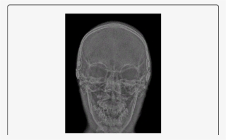 Plain Trans Orbital Skull Film Taken Intra Operatively - Medical Imaging #7988812