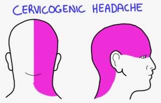 Cervicogenic-headache - Cervicogenic Headache #8002602