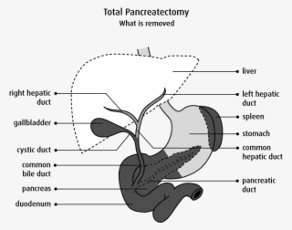 Diagram Of What Is Removed In A Total Pancreatectomy - Pancréatectomie Totale #8030218