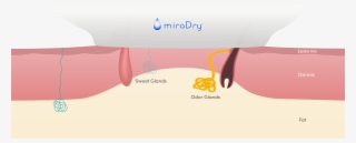 Next, The Handpiece Is Activated - Diagram #8041373
