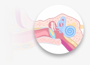 Conductive Hearing Loss - Text #814332