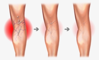 Spider And Varicose Vein Treatment Center - Varicose Vein Graphic #8147361