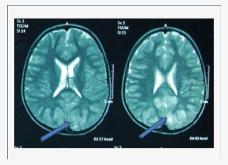 Pointers Indicating Hyper Intensity Areas In White - Computed Tomography #8163703