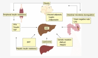 The Development Of Nafld And Nash-related Hcc Is Multifactorial - Emt Nash Hcc #8228373
