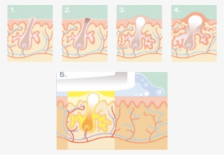 Acne And Rosacea - C1 Advanced #8268539