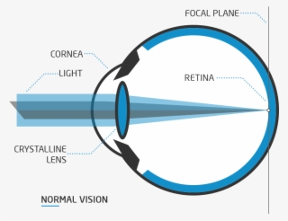 Astigmatism Surgery - Ojo Con Miopia Png #8297498