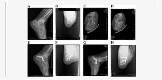 A 45 Year Old Male Patient Was Admitted To Our Hospital - Minimally Invasive Calcaneal Fracture #8356357