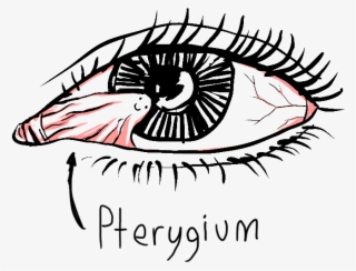 A Pterygium Is A Pinkish To Dark Red Triangular Wing #8361563