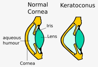 Kerataconus Image - Does Keratoconus Work #8373627