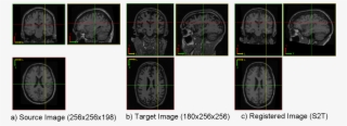 Registration Of Raw Brain Images - Computed Tomography #8393844