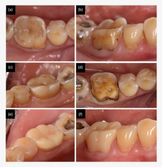 The Lower First Molar Tooth Has Large Resin Composite - Medical #8421818