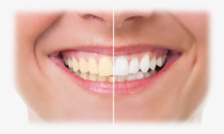 Tooth Whitening - 歯 が 黄色い リップ #8421918