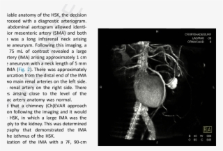 Horseshoe Kidney Classification System Based On The #8423926