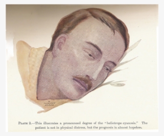 This Drawing Of A Man With Cyanosis Shows The Purple-blue - Visual Arts #8441356