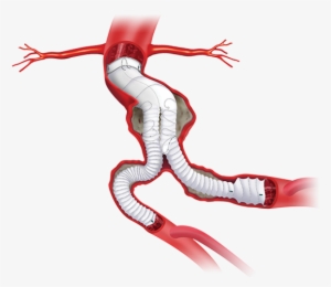 Product Availability Subject To Local Regulatory Approval - Anaconda Graft #851461