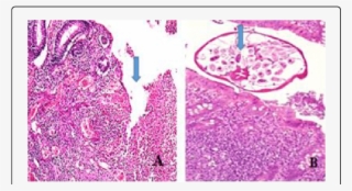 Entrobius Vermicularis In Appendix - Motif #8500644