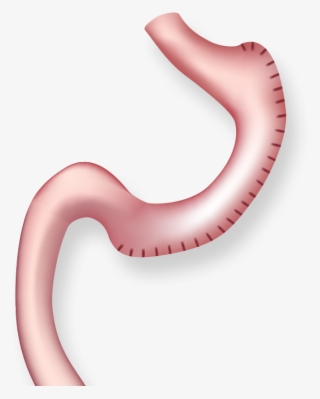 Illustration Of Stomach After Gastric Plication - Tüp Mide Ameliyatı #8574874 Illustration Of Stomach After Gastric Plication - Tüp Mide Ameliyatı #8574874