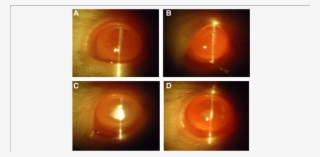Slit Lamp Images Of Eyes - Light #8621884