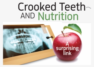Crooked Teeth And Nutrition By Dr - Apple #8682207