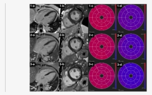 Lge Images, Native T1 And Ecv Bull's Eye Plots Of A - Circle #870048