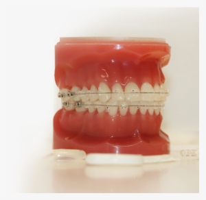 Clear Braces - Plastic #878492