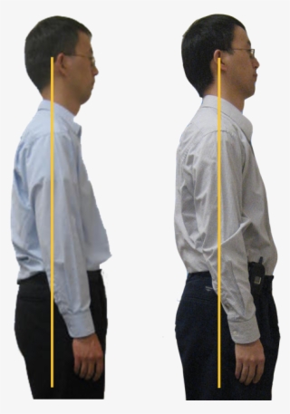 Breathing Difficulties - Forward Neck Posture Before And After #8740278