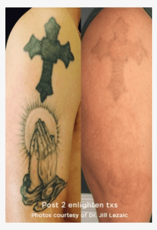 Tattoo Removal* - Tattoo #8743878