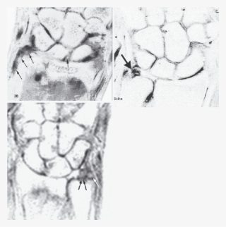 Triangular Fibrocartilage Tear Syndrome - Medical Imaging #8753391