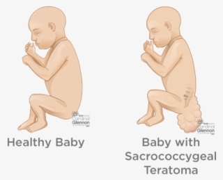 How Is Sct Diagnosed During Pregnancy - Children’s Healthcare Of Atlanta #8764945