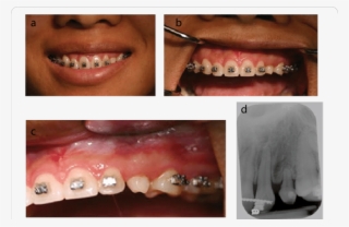 Situation After Completion Of Orthodontic Treatment - Collage #8816258