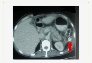 Post Operative Pancreatic Contrast Enhanced Ct Abdomen - Radiology #8916404