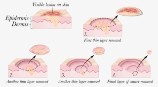 2010 Terese Winslow - Mohs Surgery #9009415