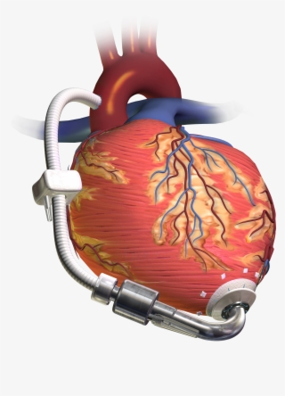 Henrico To Provide Ems Training For Patients With Heart - Heart Lvad #9010562