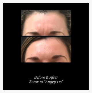 Both Botox® And Dysport Are Reversible If The Patient - Poster #9077839
