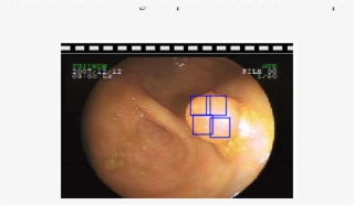 Polyps Sub-image Selection Is In General Not Overlapping - Planet #9090369 Polyps Sub-image Selection Is In General Not Overlapping - Planet #9090369