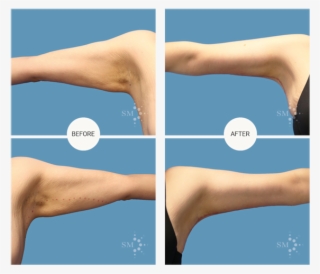 Brachioplasty - Jumping #9154240 Brachioplasty - Jumping #9154240
