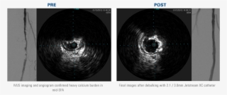 Noticeable Calcium Reduction In Right Sfa After Treatment - Calcium On Ivus #9198648