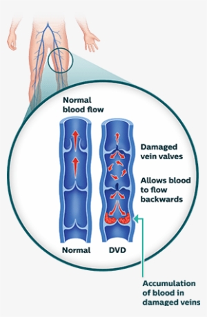 Deep Venous Disease - Dvo Deep Venous Obstruction #923440