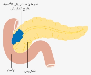 Open - Cancer De Pancreas Png #9201095