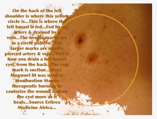 Cupping - Fire Cupping Cyst #9223544