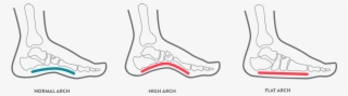 A Kids Foot Health Diagram Illustrating Arch Position - Foot Bones Kid #9227346