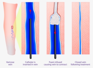 Sclerotherapy-treatment #9255061