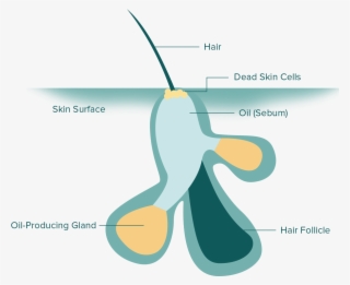 What Is Acne - Graphic Design #9313640