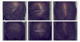 Plga Before After - Lace Wig #9330519