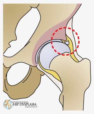 Torn Labrum Illustration [ ] Enlarge - Drawing Of Torn Labrum Hip #9370280