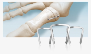 Neospan Se Compression Staple - Basic Pump #9420005