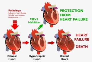 Png Transparent Stock Disease Clipart Heart Damage - Hypertrophy Heart Failure #9421768
